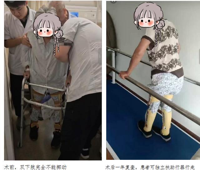七旬阿姨杨梅树上坠落致截瘫“神经移位”术帮她重获行走希望(图1)